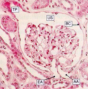 Ig A nefrit IgAN: Njurbiopsi med positiv Immunofluorescens dominerande för