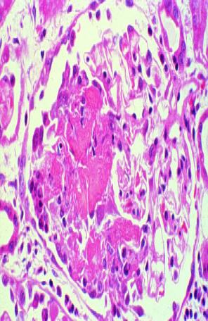 Pauci-immune (ANCA) småkärlsvaskulit - histologi Nekrotiserande arterit
