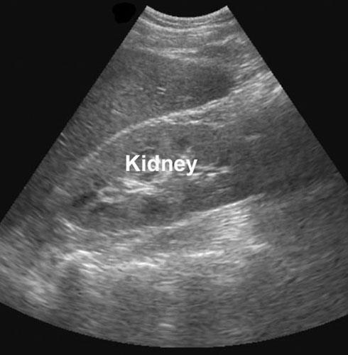 Diagnostik S-krea, CRP, SR, elfores Hematuri,