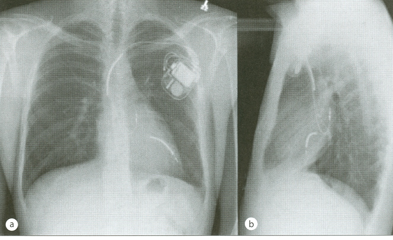 Pacemaker efter Mustard / Senning Symtomatisk bradykardi Asymtomatiska: < 40 bpm (dag) < 30 bpm (natt) Uteslut ev restshunt