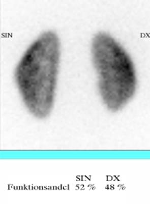 DMSA - Sta@sk njurscin@grafi 99m Tc- DMSA Tubulär fixa@on Indika@oner Parenkymskada e\er pyelonefrit Akut