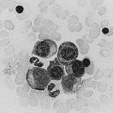 FOTO: DOKTOR OLLE RUDOLPHI Figur 2. Benmärgsutstryk från patient med CDA-III och myelom. A. En stor flerkärnig erytroblast ses något till höger, ovanför ses två plasmaceller. B. Centralt ses en erytroblast med fyra kärnor.
