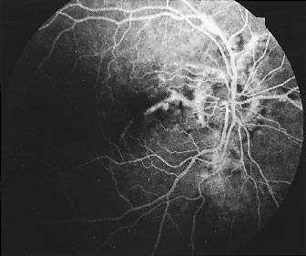 FOTO: DOCENT OLA SANDGREN Figur 3. Flourescein angiografi av höger öga.»angioid streaks» hos en 71-årig kvinna med CDA-III.
