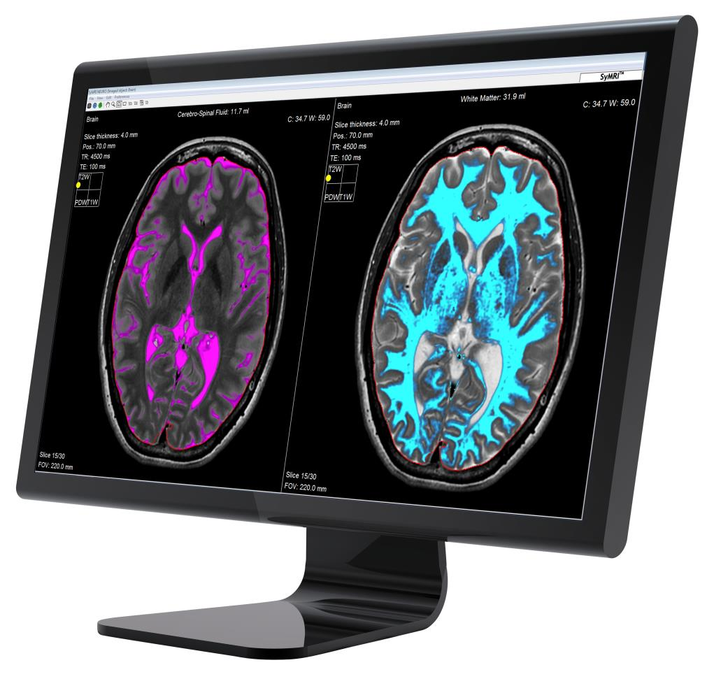 9 Används för uppföljning av MSpatienter SyMRI IMAGE och NEURO används sedan 2011 vid Umeå universitetssjukhus för uppföljning av behandlingseffektivitet vid multipel skleros (MS).