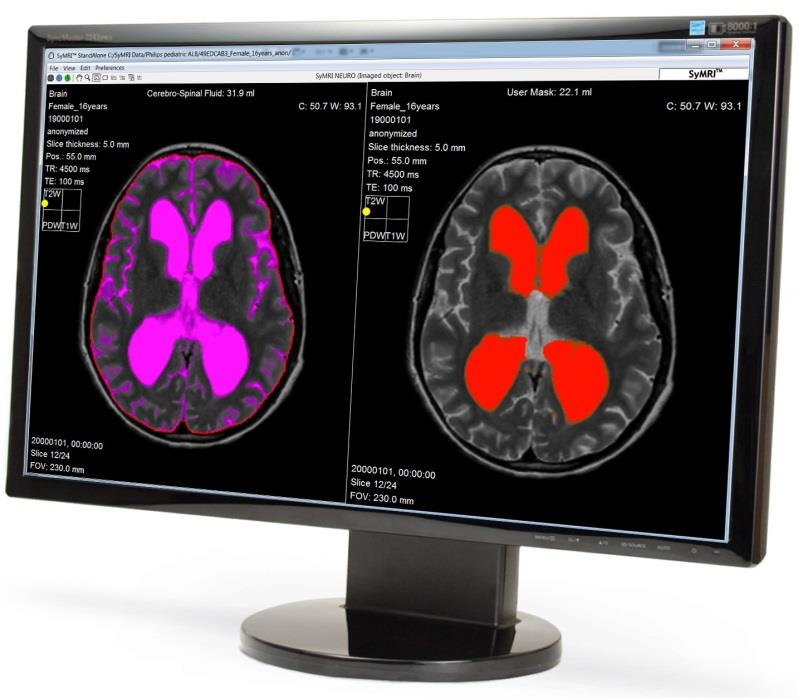 2 Det här är SyntheticMR SyntheticMR AB har utvecklat SyMRI, en programvara som effektiviserar och förbättrar undersökningar med magnetisk resonanstomografi (MR eller MRI på engelska).