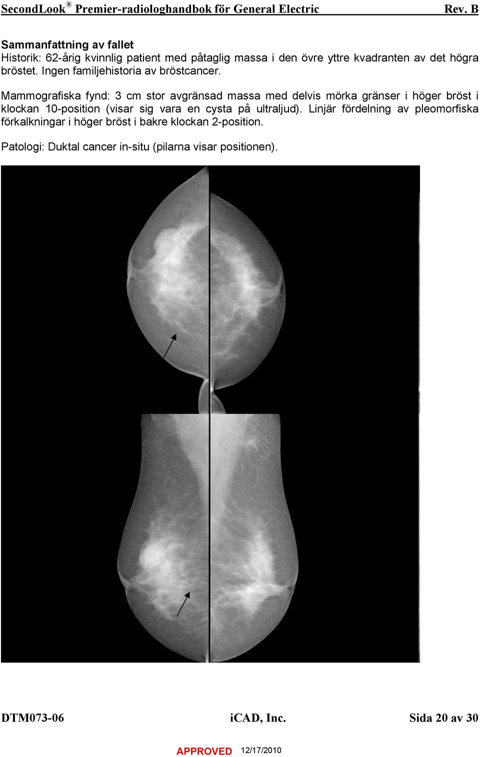 Mammografiska fynd: 3 cm stor avgränsad massa med delvis mörka gränser i höger bröst i klockan 10-position (visar sig vara