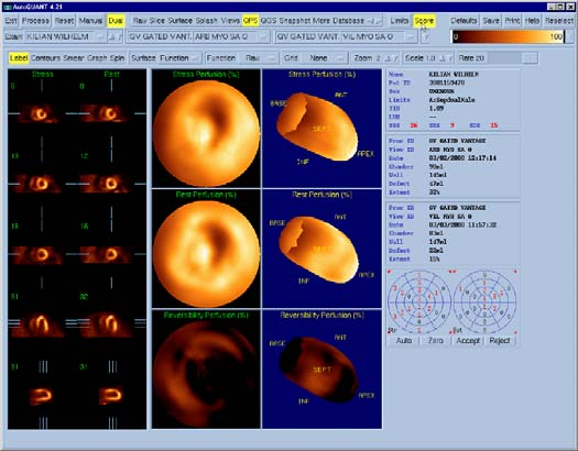 Bull s eye presentation Michael Ljungberg/Medical Radiation Physics/Clinical Sciences Lund/Lund University/Sweden