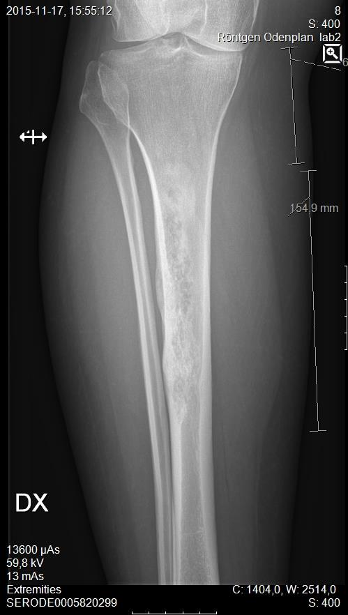 Resultat och diskussion Patient 3 Adamantinom i höger tibia Status oktober 2016 (ca 8 månader post op) Reopererades 7 månader post op Den distala delen av benet hade