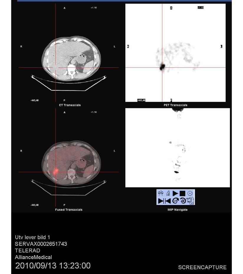 FDG-PET/CT vid