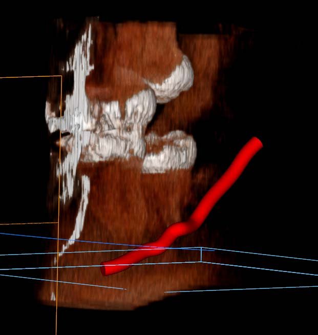 3D- nerve tracking