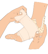 AKUT OMHÄNDERTAGANDE AV FOTLEDSSTUKNING 1.Ta av sko och strumpa och inspektera foten så att inga felställningar syns. 2.