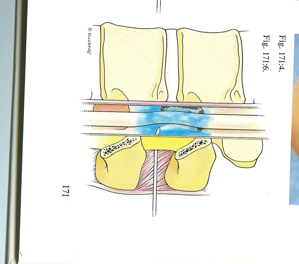 Epidural/