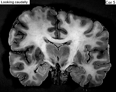Tentamen NURR 20/3-07 sid 3(16) 4. (4p) Figuren visar ett koronarsnitt genom hjärnan. Markera (i figuren) och namnge de olika delar av ventrikelsystemet som kan identifieras i figuren.