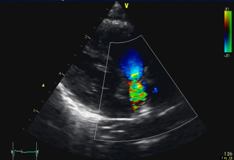 Diagnostik pulmonalstenos Ultraljudsbilder EKG Högerkammarhypertrofi Ekokardiografi 2D beskrivning Doppler mäter hastighet,