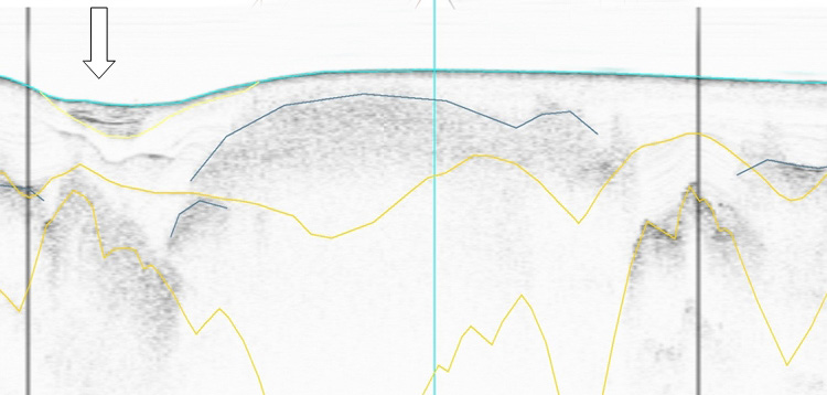 S N Figur 10. Sedimentekolodsprofil från linje 07b_0120 med prov 07b_016 inlagd med blå vertikal linje.