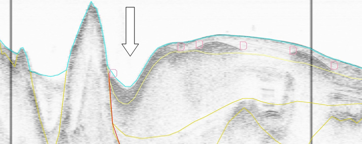 S N Figur 17. Sedimentekolod linje 07a_073. Djuphålan är troligen berggrundsbetingad. Röd linje markerar bergytan. Pilen visar djuphålan där dumpningsplatsen ligger. Tabell 9.