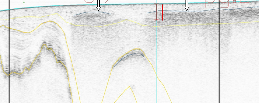 SO N Figur 34. Sedimentekolodprofil från linje 07b_194. Prov 07b_056 ligger vid blå vertikal linje och provets längd visas med röd linje.