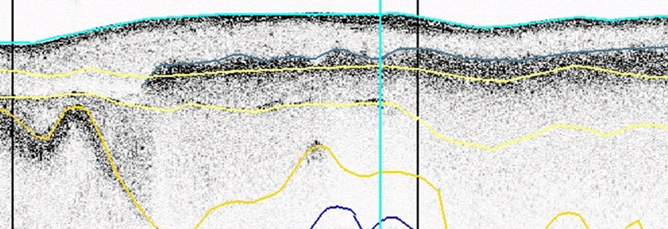 NO SV Figur 47. Mätlinje 08b_009 visar att det finns postglacial gyttjelera ovanför den övre ljusgula linjen. Den grå linjen visar var det finns gas i den postglaciala leran.