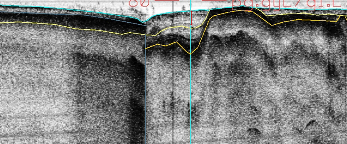 O V Figur 50. Sedimentekolodprofil 08a_042 visar den djupa hålan söder om Fredagsholmen. Hålans uppkomst beror sannolikt på ökad ström och ökad erosion i sundet, se pil.
