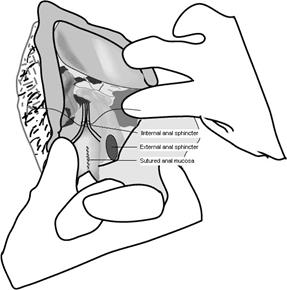 Illustration: Pelle Lindquist.(9) Ligger sfinkterändarna brett isär är det till hjälp att först adaptera mellangårdens muskelfästen med levatorerna så att sfinktersuturerna kan sättas utan spänning.