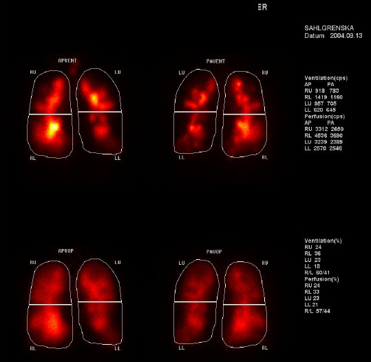 Radiospirometri regional