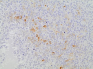 Hypofysadenom, diagnosdska kriterier: immunhistokemiskt hormonu$ryck GH ProlakDn ACTH LH Hormon- negadvt adenom Null- cell adenom: Inget hormonu$ryck