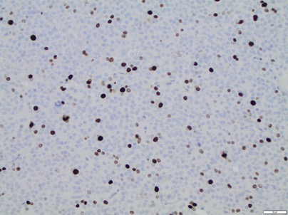 CellproliferaDon i hypofysadenom Ki67 index