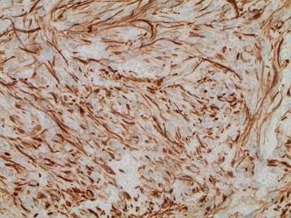 Pituicytoma GFAP Histologiskt benign tumör i hypofysens baklob eller i hypofysstjälken. DifferenDering mot pituicyter / modifierade gliaceller i neurohypofysen.