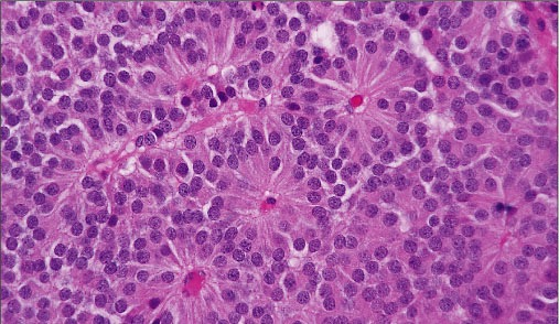 Hypofyspatologi Endokrin hypofystumör/hypofysadenom > 90% av alla patologiska förändringar i