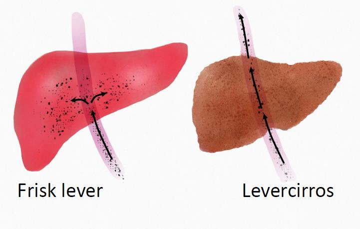 Leverns funktion Levern är kroppens största inre organ. Det är ett viktigt organ som vi behöver för att överleva.