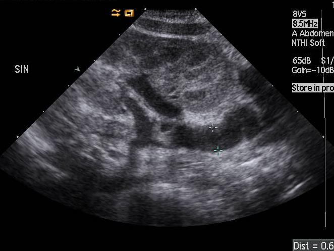 1 mån gammal pojke med pyelonefrit där ultraljud visat vä sidig