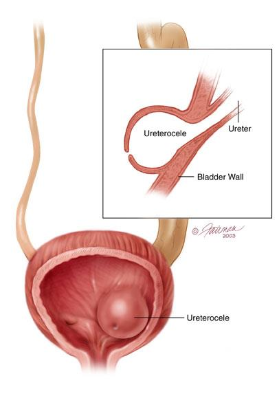 Uretärocele Dilatation av intravesikala delen av uretären Oftast i