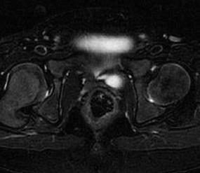 Neoimplantation utfördes