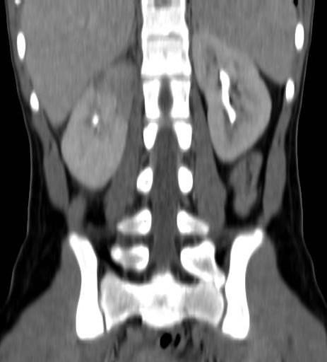 Behandlingsresistent pyelonefrit Abscess?