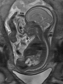 Foster v 18 där man på prenatalt ultraljud sett slingriga