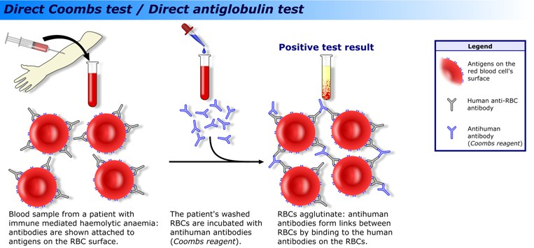 Direkt AntiglubulinTest (DAT): detekterar antikroppar eller