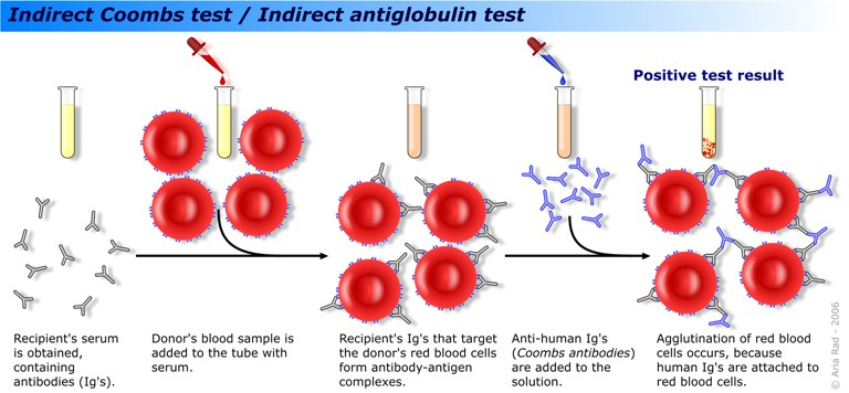 Indirekt antiglobulintest (IAT): antikroppar i serum