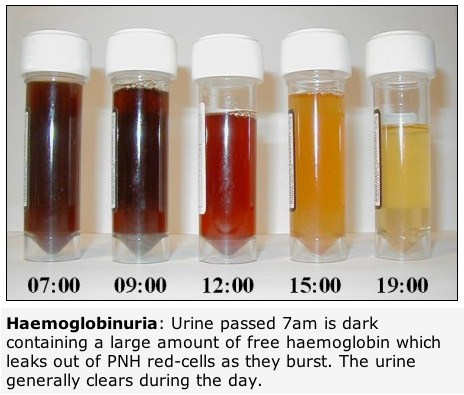 Paroxysmal nocturn hemoglobinuria (PNH) Intravasal komplementmedierad hemolys Cytopenier (aplastisk anaemi och myelodysplastiskt