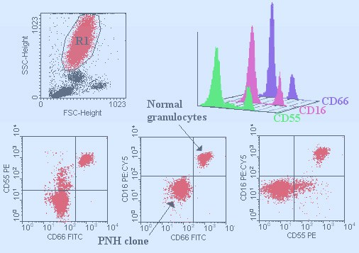 PNH-diagnostik (Ham s test) (Sucrostest)