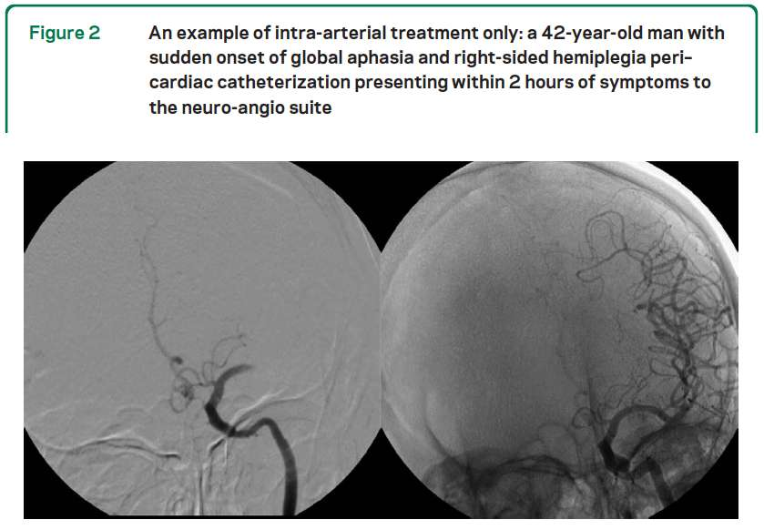 TROMBOLYSBEHANLING Exempel: akut ischemisk stroke +22 mg