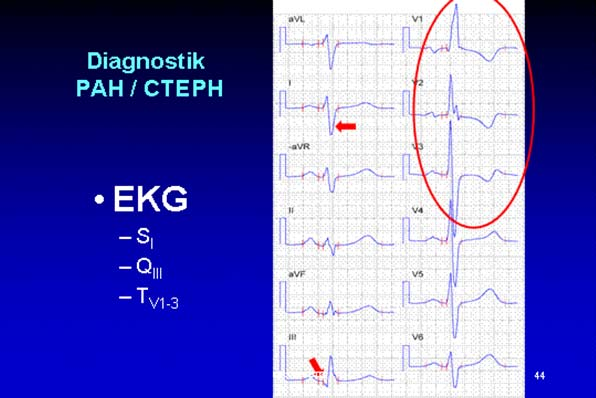 EKG vid