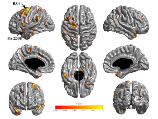 att tonårsflickor övat sig på Tetris i 3 månader fmri