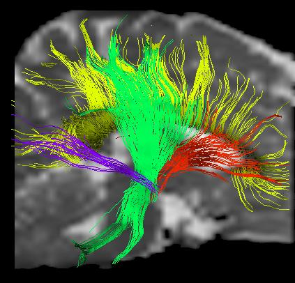 Diffusion tensor imaging Samband mellan den