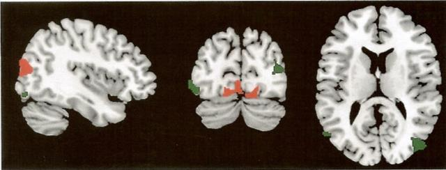 patienter med sociala ångestsyndrom Münte, Altenmüller & Jäncke, 2002 Rött