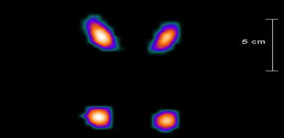 Figur 4. Exempel på ett automatiskt ROI beräknat utifrån SPECT/CT-data. Bilden redogör för ett coronalsnitt (överst) och transversalsnitt (nederst).