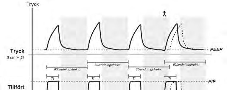 Ventilationsfunktioner (A)CV-andningsmönster som visar ett patienttriggat andetag bland tidstriggade andetag, med inandningens tidslängd definierad enligt Ti.