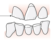 12 (48) Exempel, omfattande defekt vid fraktur En patient frakturerar den buckala väggen på tand 15. Tanden är sedan tidigare försedd med en fyllning mesialt, ocklusalt och distalt.