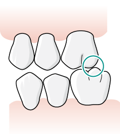 bettavvikelse. Bettslipning inom diagnos/tillstånd 5071 eller 5072 kan utföras som en del i behandlingen. Det medför att protetiken omfattar färre tänder eller blir mindre komplicerad att utföra.