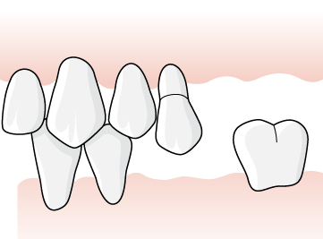 21 (48) Exempel, betthöjning genom kronterapi vid slitagebett En patient har genom tandslitage i ett protruderat läge förlorat mer än en tredjedel av kronhöjden på tänderna 33-43.
