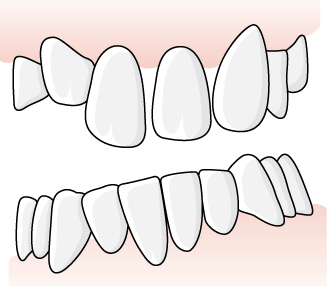 Tandläkaren föreslår att de nedslitna tänderna 33-43 ska kronförses. Vid behandlingen måste bettet höjas. Betthöjningen innebär att tuggkontakten förloras mellan tänderna i sidopartierna.